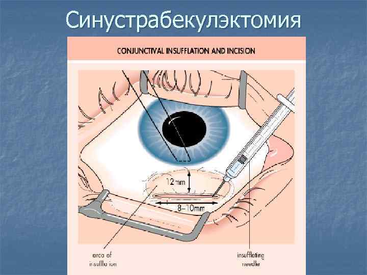 Синустрабекулэктомия 