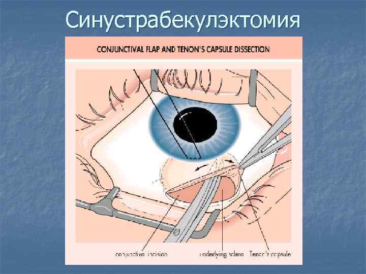 Синустрабекулэктомия 