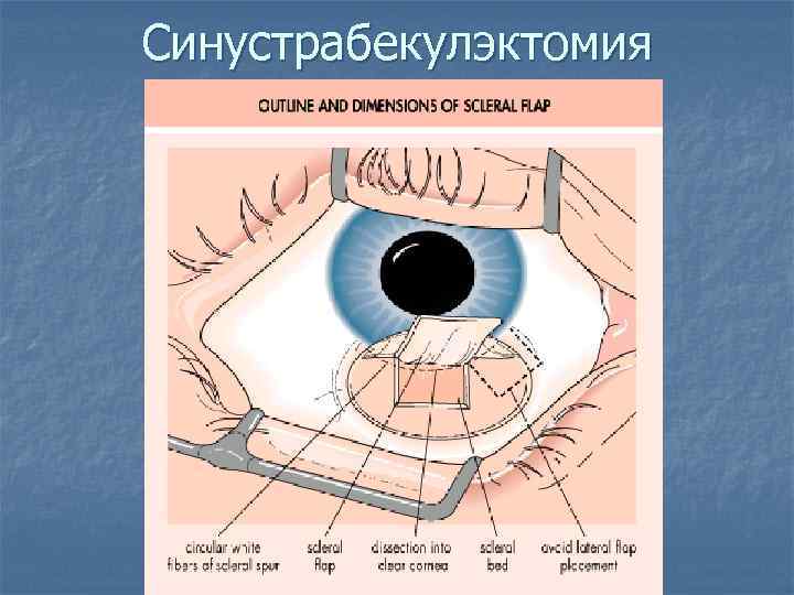 Синустрабекулэктомия 