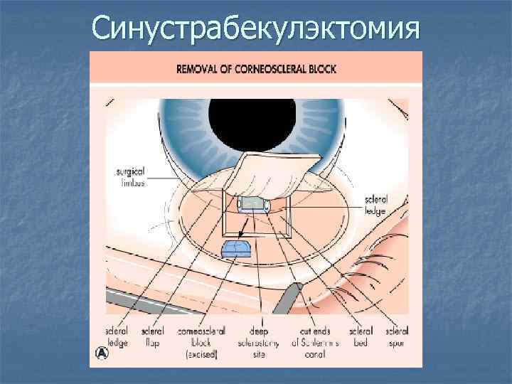 Синустрабекулэктомия 