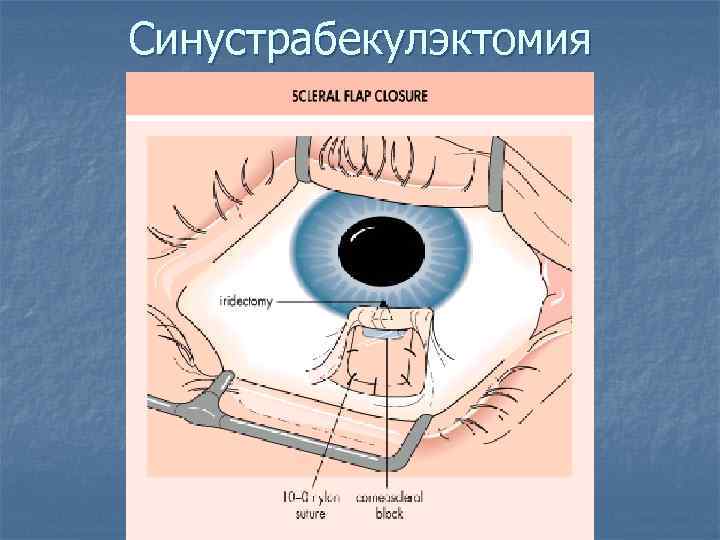 Синустрабекулэктомия 