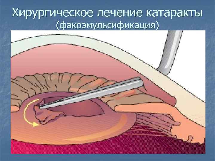 Хирургическое лечение катаракты (факоэмульсификация) 