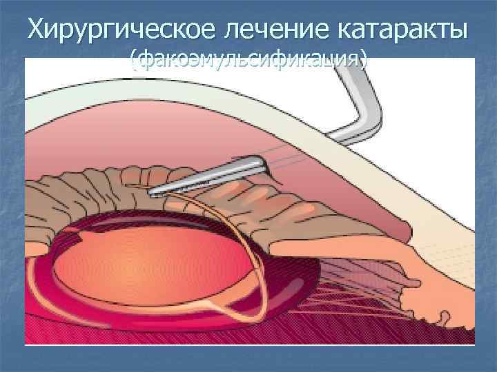 Хирургическое лечение катаракты (факоэмульсификация) 