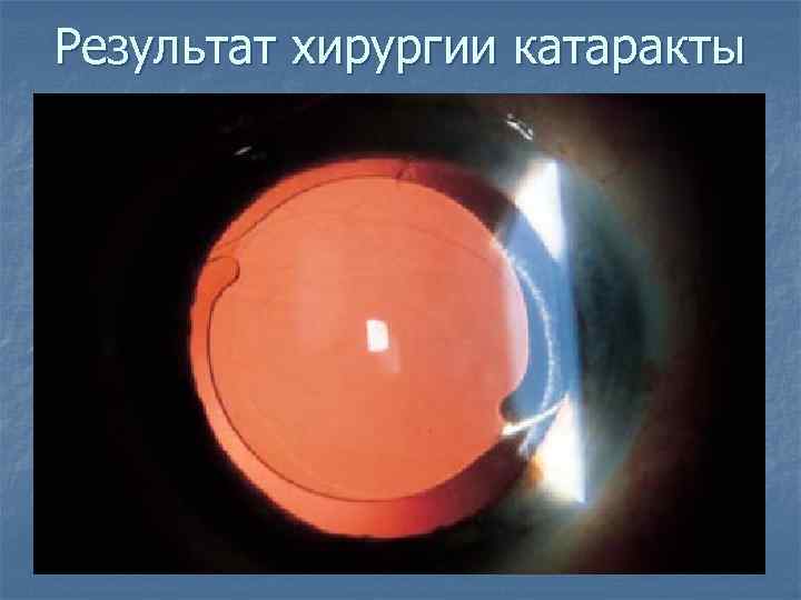 Результат хирургии катаракты 