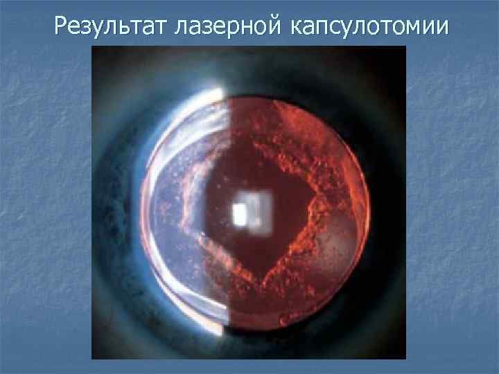 Результат лазерной капсулотомии 