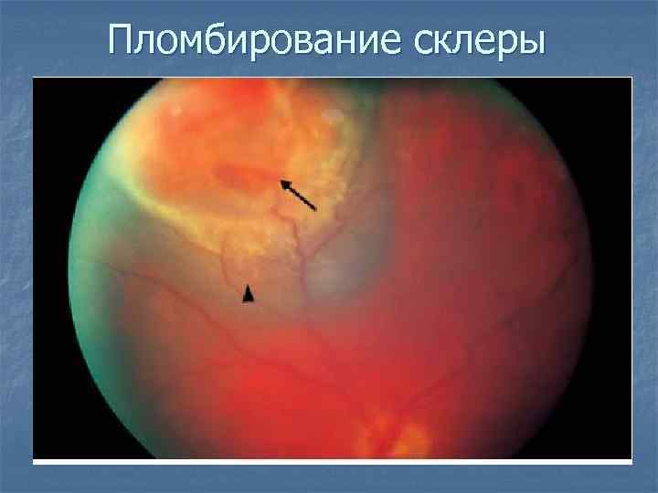 Пломбирование склеры 