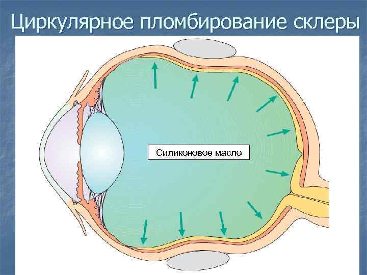 Циркляж