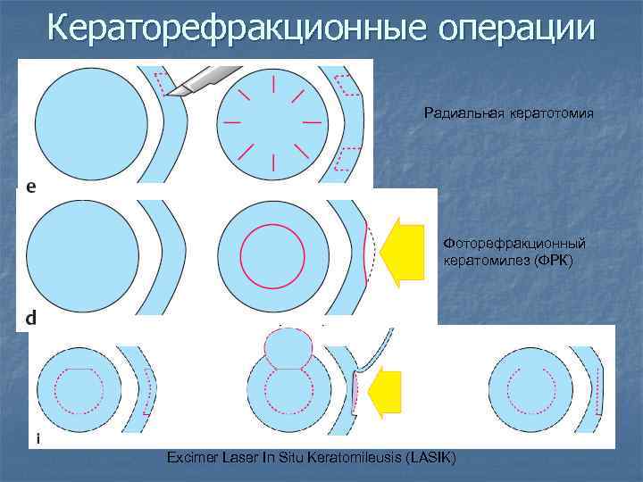 Кераторефракционные операции Радиальная кератотомия Фоторефракционный кератомилез (ФРК) Excimer Laser In Situ Keratomileusis (LASIK) 