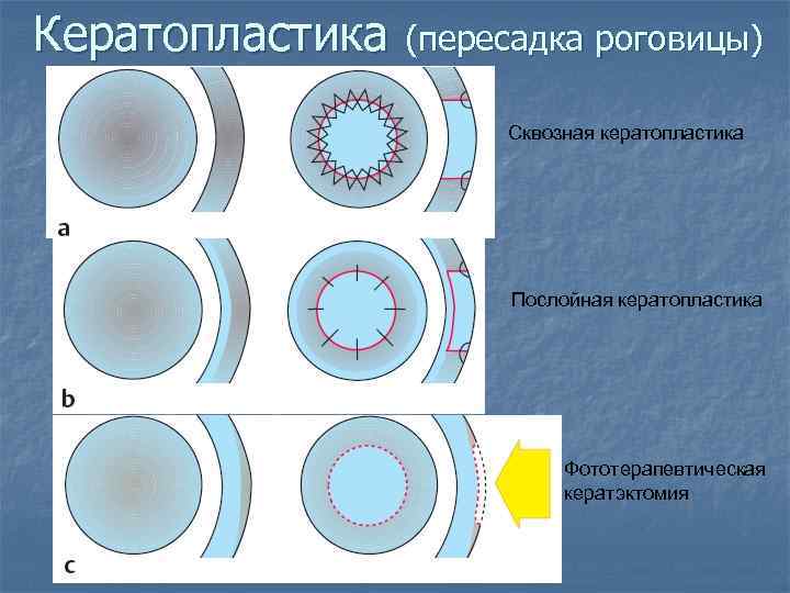 Кератопластика (пересадка роговицы) Сквозная кератопластика Послойная кератопластика Фототерапевтическая кератэктомия 