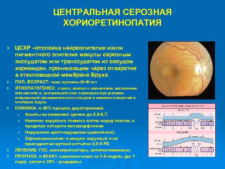 ЦЕНТРАЛЬНАЯ СЕРОЗНАЯ ХОРИОРЕТИНОПАТИЯ Ø ЦСХР –отслойка нейроэпителия и/или пигментного эпителия макулы серозным экссудатом или