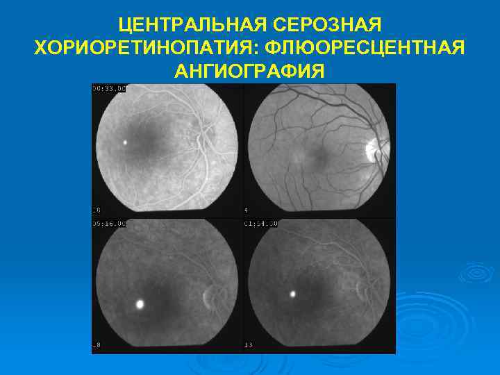 ЦЕНТРАЛЬНАЯ СЕРОЗНАЯ ХОРИОРЕТИНОПАТИЯ: ФЛЮОРЕСЦЕНТНАЯ АНГИОГРАФИЯ 