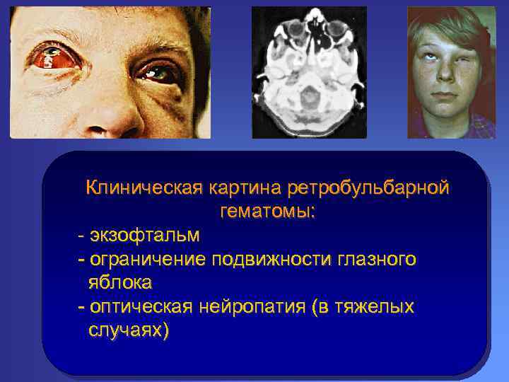 Клиническая картина ретробульбарной гематомы: - экзофтальм - ограничение подвижности глазного яблока - оптическая нейропатия