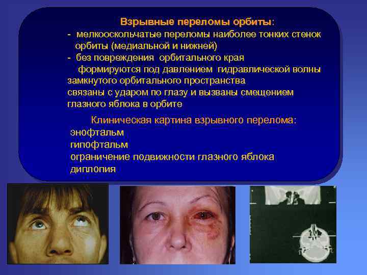 Взрывные переломы орбиты: - мелкооскольчатые переломы наиболее тонких стенок орбиты (медиальной и нижней) -