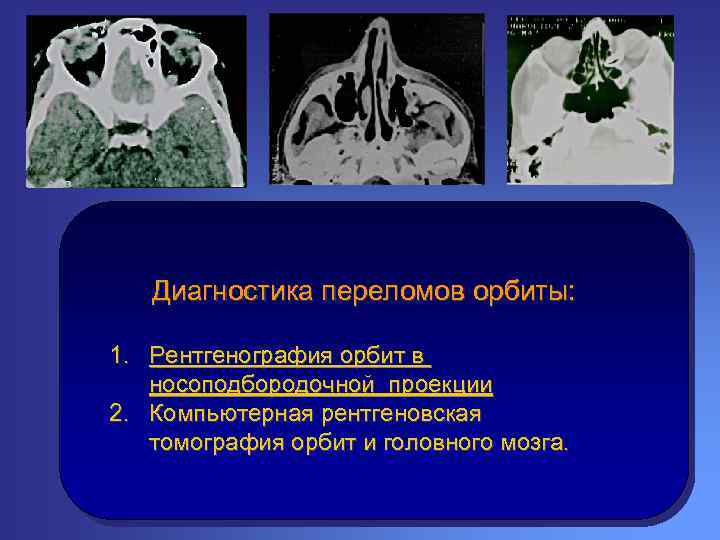 Диагностика переломов орбиты: 1. Рентгенография орбит в носоподбородочной проекции 2. Компьютерная рентгеновская томография орбит