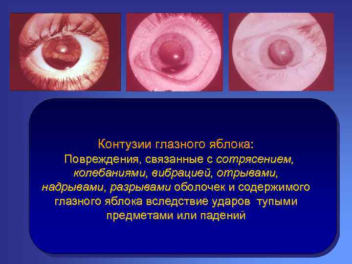 Контузии глазного яблока: Повреждения, связанные с сотрясением, колебаниями, вибрацией, отрывами, надрывами, разрывами оболочек и