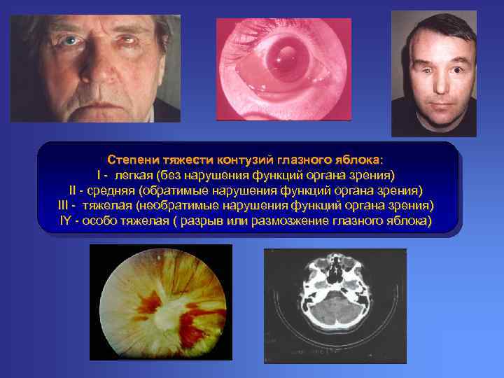 Степени тяжести контузий глазного яблока: I - легкая (без нарушения функций органа зрения) II