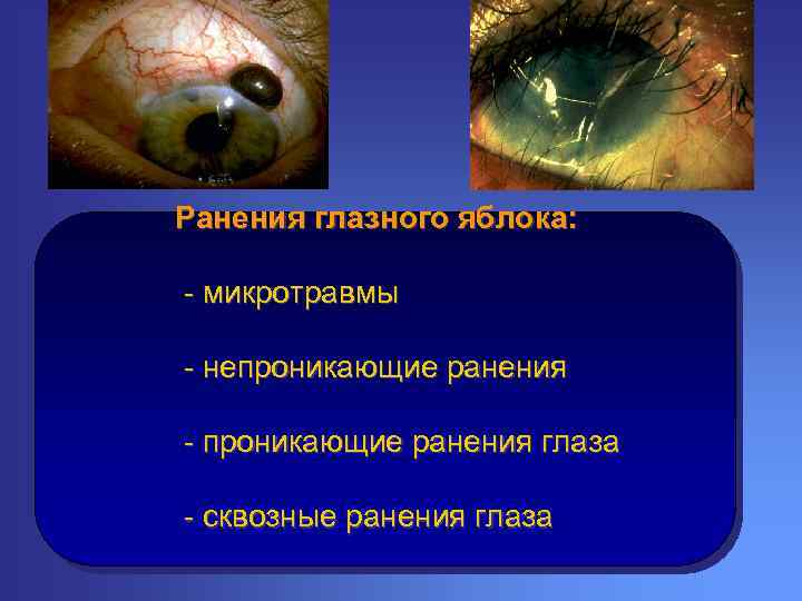 Ранения глазного яблока: - микротравмы - непроникающие ранения - проникающие ранения глаза - сквозные
