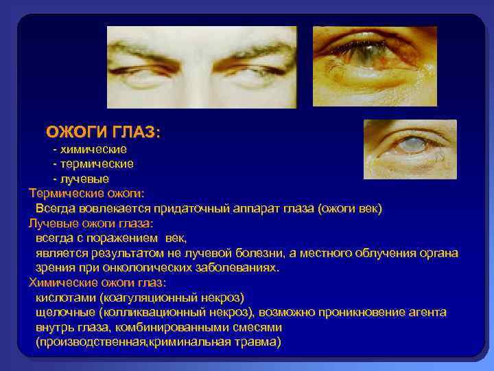 ОЖОГИ ГЛАЗ: - химические - термические - лучевые Термические ожоги: Всегда вовлекается придаточный аппарат