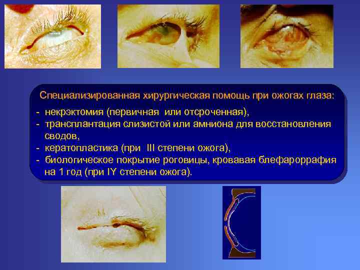 Специализированная хирургическая помощь при ожогах глаза: - некрэктомия (первичная или отсроченная), - трансплантация слизистой