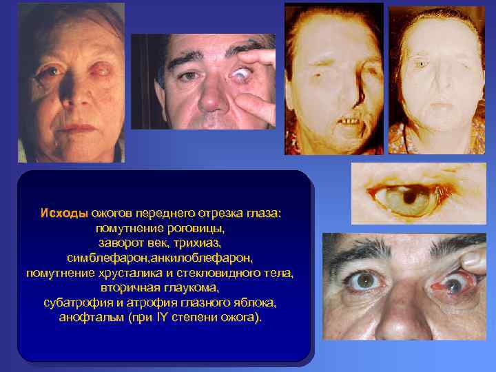 Исходы ожогов переднего отрезка глаза: помутнение роговицы, заворот век, трихиаз, симблефарон, анкилоблефарон, помутнение хрусталика