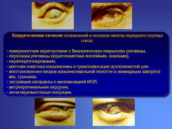 Хирургическое лечение осложнений и исходов ожогов переднего отрезка глаза: - поверхностная кератэктомия с биологическим