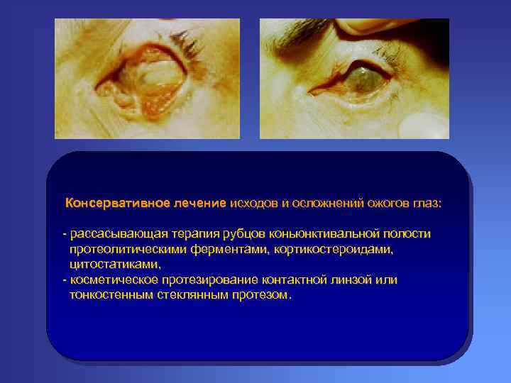 Консервативное лечение исходов и осложнений ожогов глаз: - рассасывающая терапия рубцов коньюнктивальной полости протеолитическими