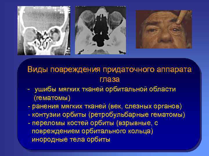 Виды повреждения придаточного аппарата глаза - ушибы мягких тканей орбитальной области (гематомы) - ранения