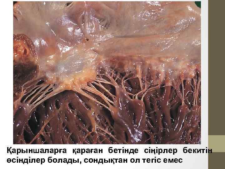 Қарыншаларға қараған бетінде сіңірлер бекитін өсінділер болады, сондықтан ол тегіс емес 