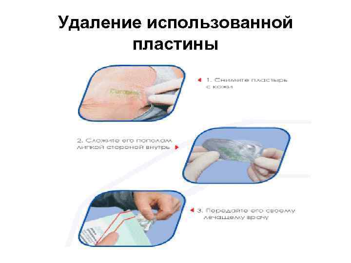 Удаление использованной пластины 