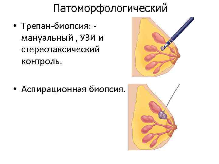 Патоморфологический • Трепан-биопсия: мануальный , УЗИ и стереотаксический контроль. • Аспирационная биопсия. 