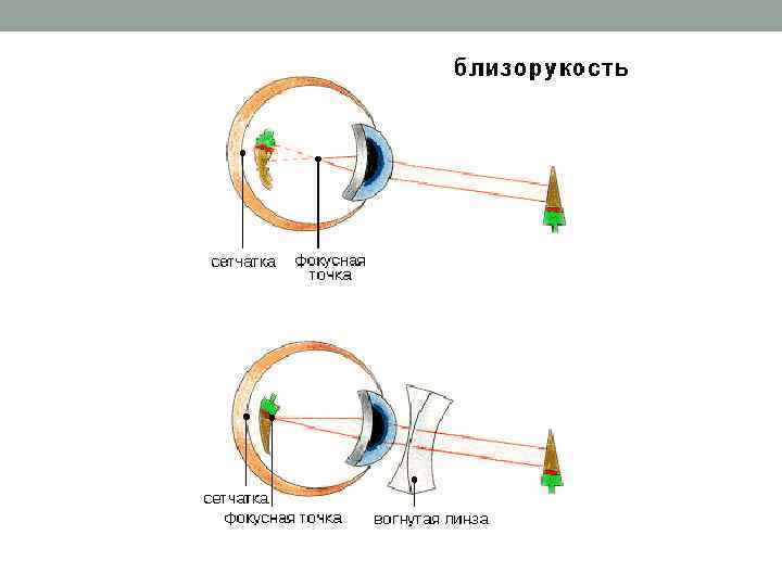 Близорукость сетчатка. У дальнозорких людей изображение фокусируется позади сетчатки. Атропинизация при близорукости. Близорукость -2,5.