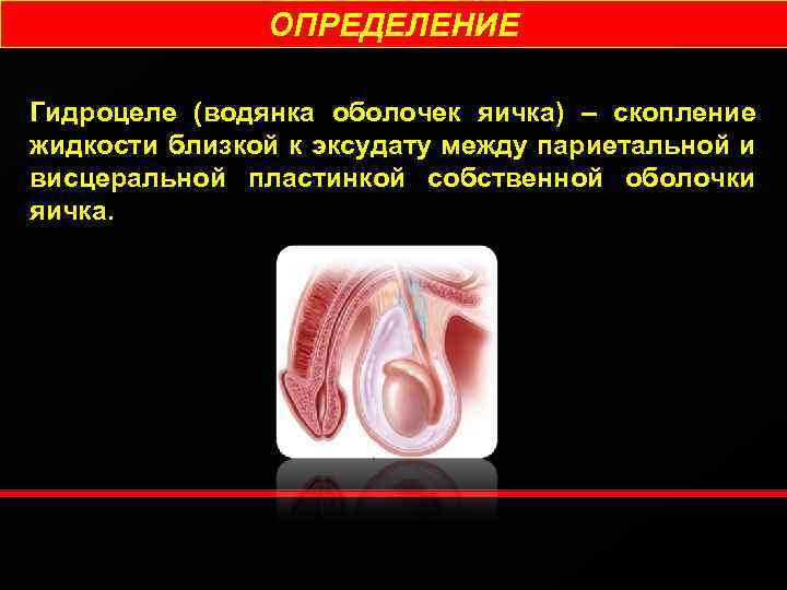 ОПРЕДЕЛЕНИЕ Гидроцеле (водянка оболочек яичка) – скопление жидкости близкой к эксудату между париетальной и