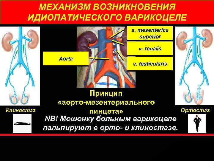 МЕХАНИЗМ ВОЗНИКНОВЕНИЯ ИДИОПАТИЧЕСКОГО ВАРИКОЦЕЛЕ a. mesenterica superior v. renalis Aorta Клиностаз v. testicularis Принцип