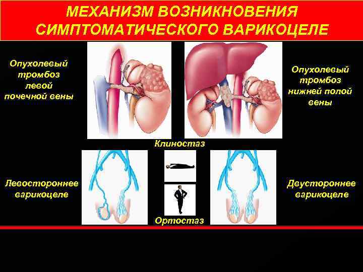 МЕХАНИЗМ ВОЗНИКНОВЕНИЯ СИМПТОМАТИЧЕСКОГО ВАРИКОЦЕЛЕ Опухолевый тромбоз левой почечной вены Опухолевый тромбоз нижней полой вены