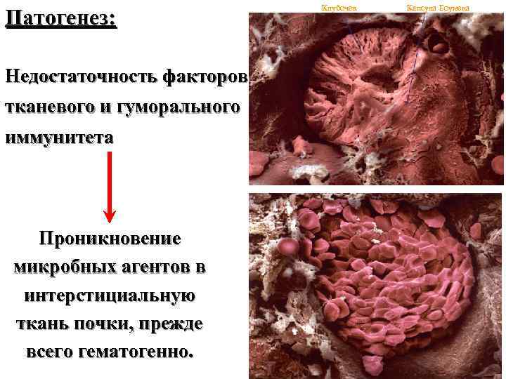 Патогенез: Недостаточность факторов тканевого и гуморального иммунитета Проникновение микробных агентов в интерстициальную ткань почки,