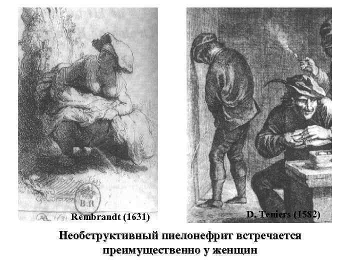 Rembrandt (1631) D. Teniers (1582) Необструктивный пиелонефрит встречается преимущественно у женщин 