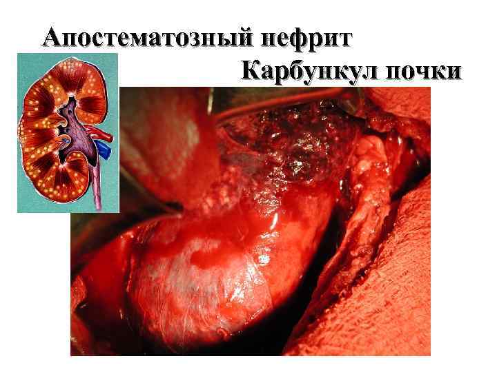 Апостематозный нефрит Карбункул почки 