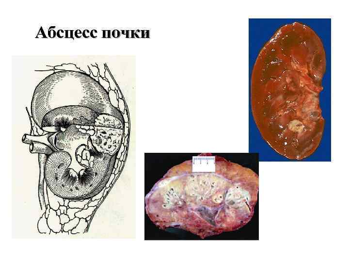 Абсцесс почки 