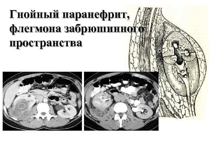 Гнойный паранефрит, флегмона забрюшинного пространства 