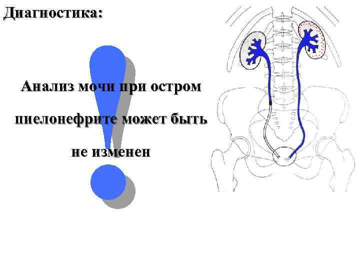 ! Диагностика: Анализ мочи при остром пиелонефрите может быть не изменен 