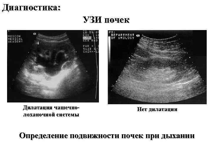 Диагностика: УЗИ почек Дилатация чашечнолоханочной системы Нет дилатации Определение подвижности почек при дыхании 