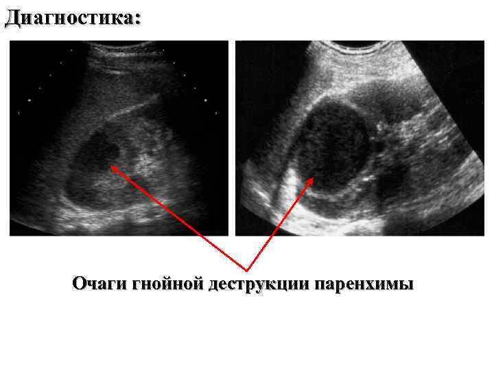 Диагностика: Очаги гнойной деструкции паренхимы 