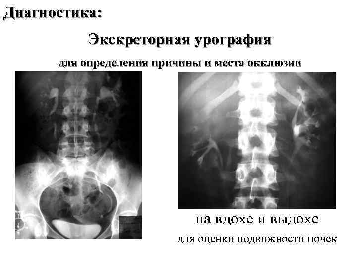 Диагностика: Экскреторная урография для определения причины и места окклюзии на вдохе и выдохе для