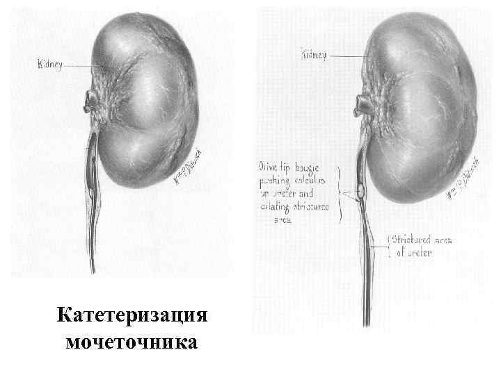 Катетеризация мочеточника 