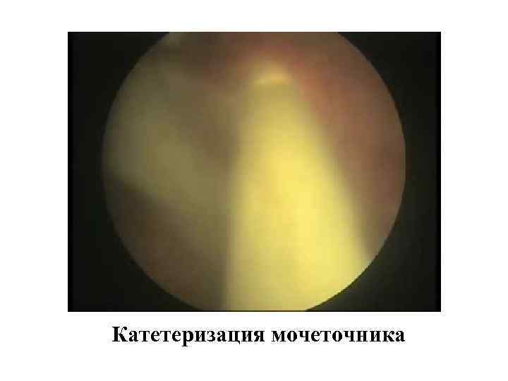 Катетеризация мочеточника 