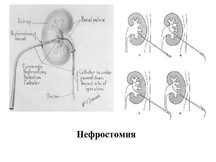 Нефростомия 