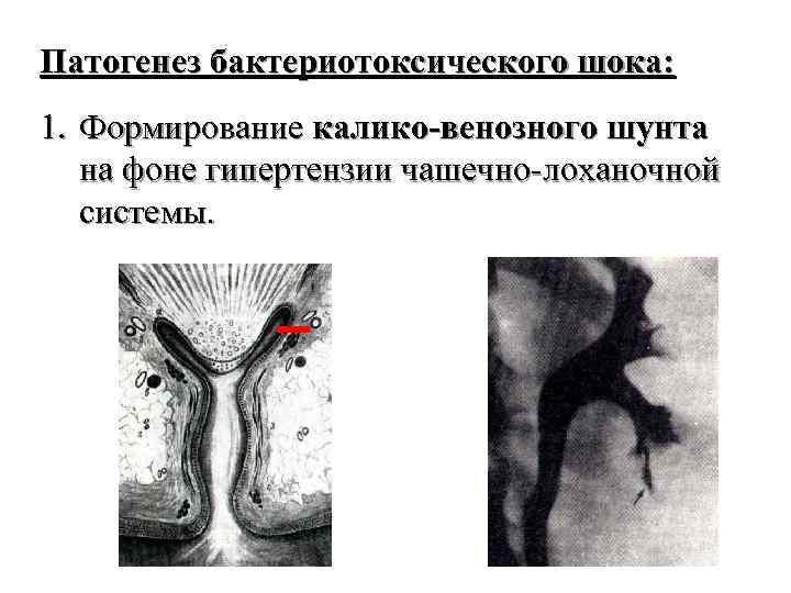 Патогенез бактериотоксического шока: 1. Формирование калико-венозного шунта на фоне гипертензии чашечно-лоханочной системы. 