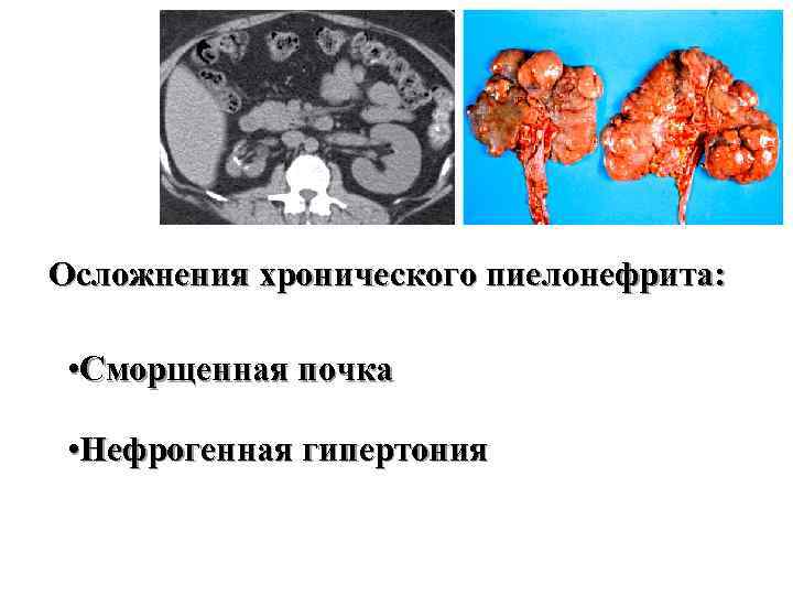 Осложнения хронического пиелонефрита: • Сморщенная почка • Нефрогенная гипертония 