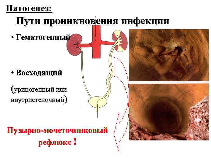 Патогенез: Пути проникновения инфекции • Гематогенный • Восходящий (уриногенный или внутристеночный) Пузырно-мочеточниковый рефлюкс !