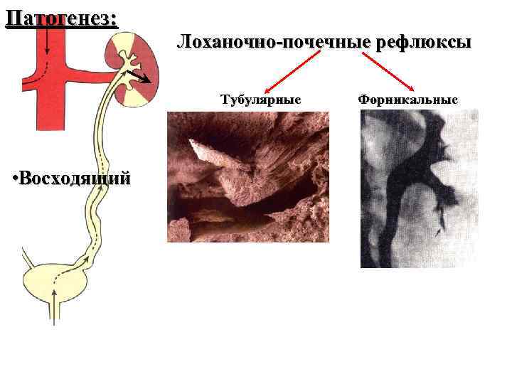 Патогенез: Лоханочно-почечные рефлюксы Тубулярные • Восходящий Форникальные 